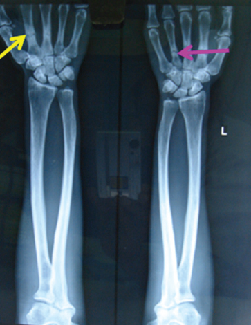 Fractures at the metacarpals on both the hands.